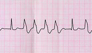 Folge von Extrasystolen am EKG sichtbar