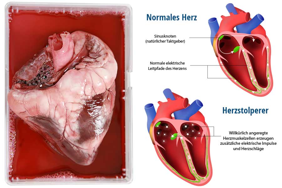 Menschliches Herz: Normaler Rhythmus und Herzstolperer