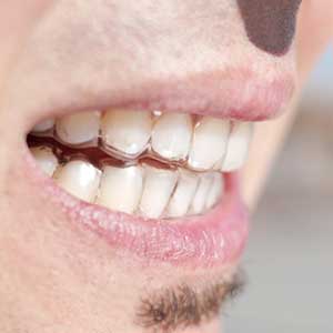 Mann trägt Zahnschutz gegen Bruxismus