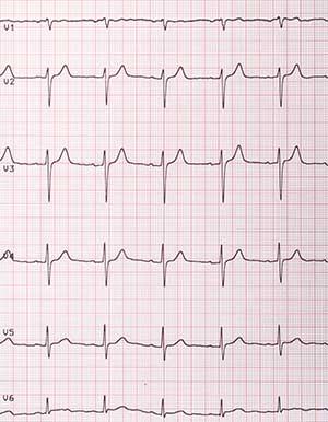 EKG auf Papier